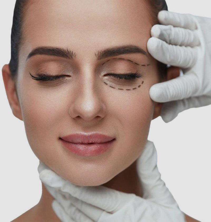 Blepharoplasty