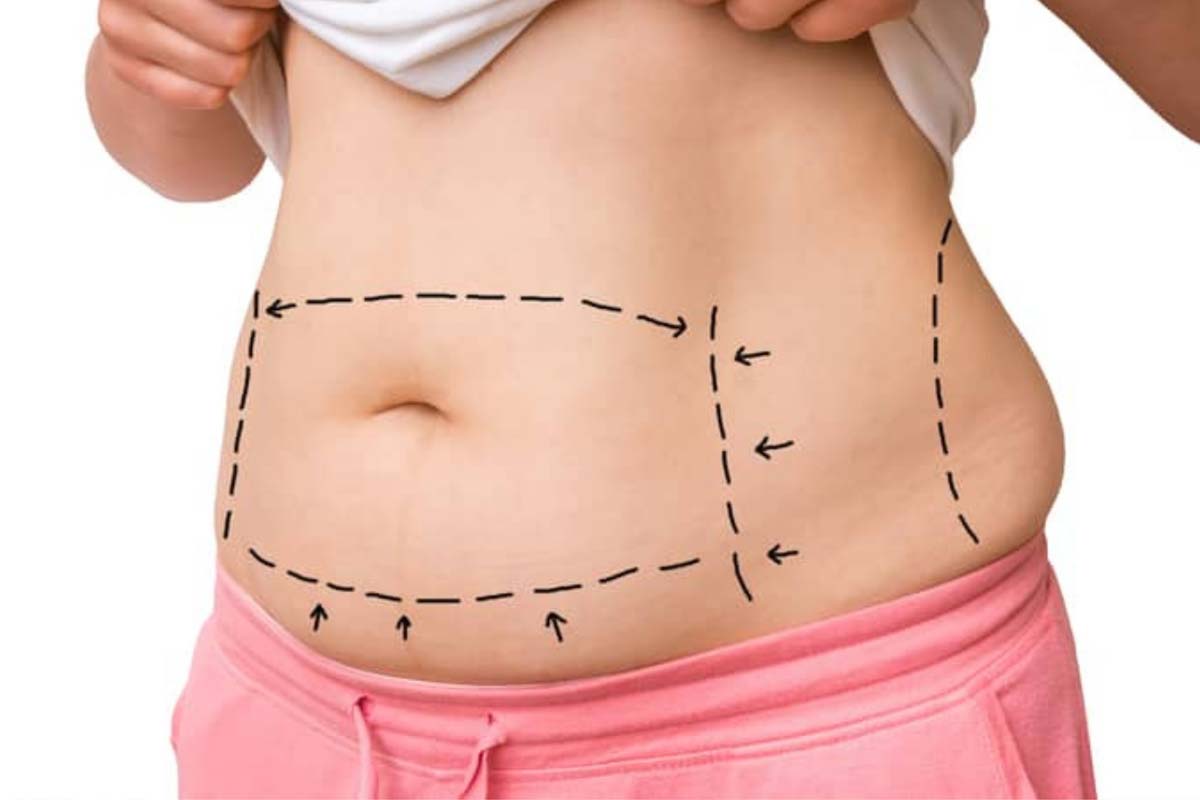 Tummy Tuck by Shape Aesthetics